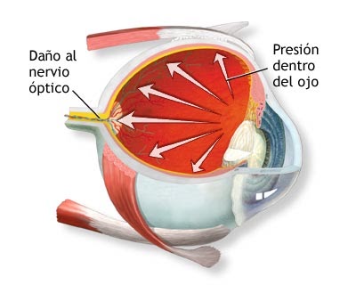 Glaucoma secundario a esteroides